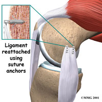MCL Surgery in Seattle WA | Bellevue Knee Specialist