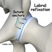 Hip Labral Surgery in Kirkland