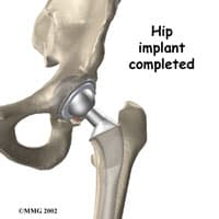 Hip Replacement Surgery in Kirkland
