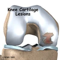 Knee Cartilage Injury Treatment