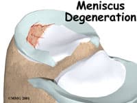Mensicus Knee Surgery in Kirkland