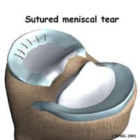 Meniscus Repair Surgery in Kirkland