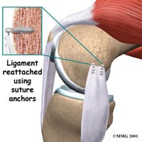 MCL Injury Treatment in Kirkland