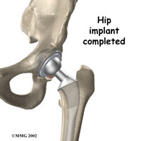 Hip Replacement Surgery in Kirkland, WA | Robin Fuchs, MD