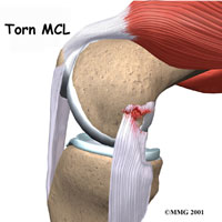 MCL Tear Causes & Treatment  Florida Orthopaedic Institute
