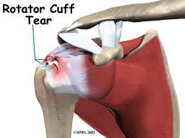 rotator cuff tendinitis