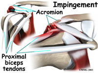 bicep tendonitis bpc 157 Biceps Tendinitis Treatment & More