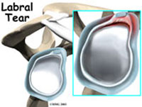 Labral and SLAP Tear Treatment in Kirkland | Robin Fuchs, MD